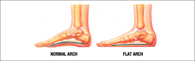 Metro Foot and Ankle Centers, PC | Flatfoot Reconstruction
